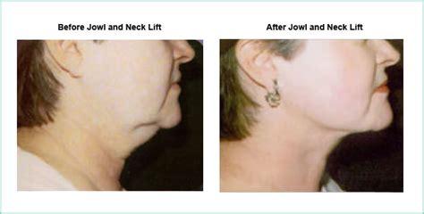 Neck And Jowl Lift Austin Texas Central Texas Dermatology