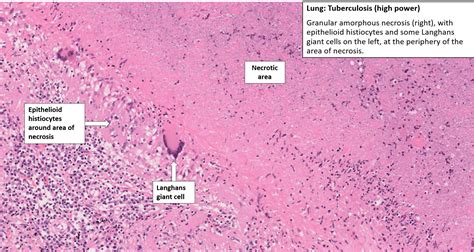 Tuberculosis Lymph Node Histology