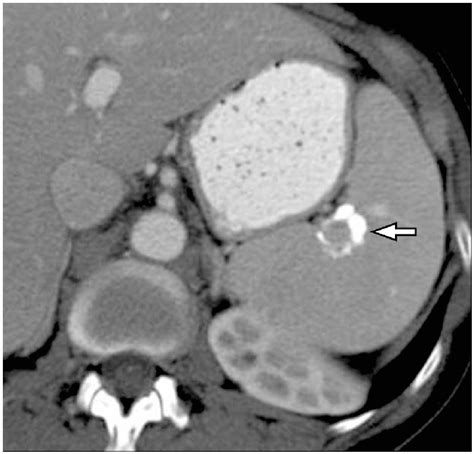 Calcified Splenic Metastasis From Ovarian Cancer Contrast Enhanced Ct