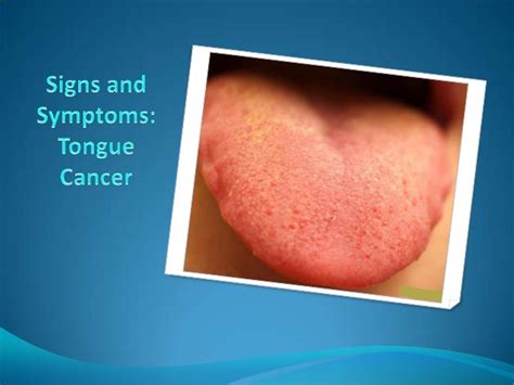 What some oral (mouth) cancers look like these photographs are not meant to scare you. Signs and symptoms tongue cancer