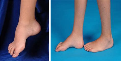 Surgical Outcomes Of Cavovarus Foot Deformity In Children With Charcot