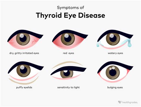 Thyroid Eye Disease Definition Symptoms Causes And More