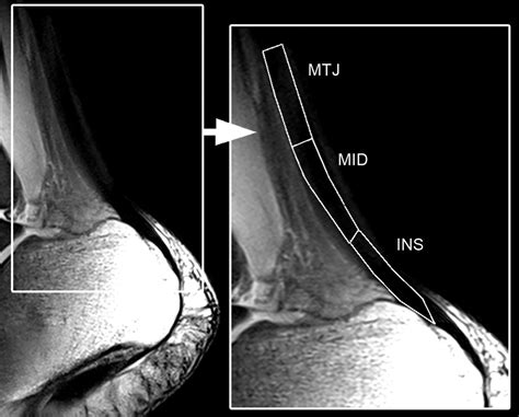 Sodium Mr Imaging Of Achilles Tendinopathy At 7 T Preliminary Results Radiology