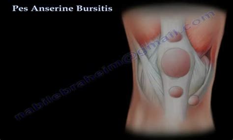 Pes Anserine Bursitis Knee Pain Everything You Need To Know Dr Nabil Ebraheim