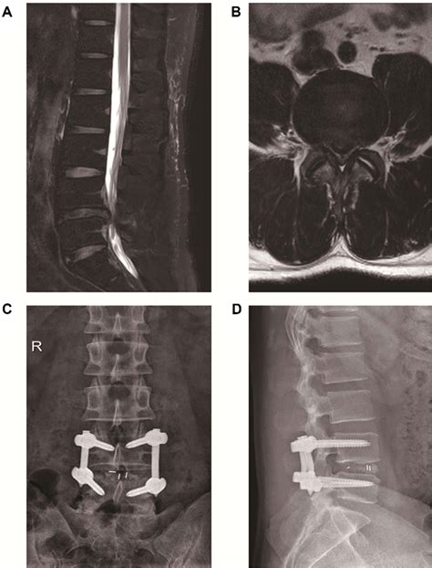 A Case Of Mis Tlif Surgery Notes A And B Lumbar Mri Revealed L4 5
