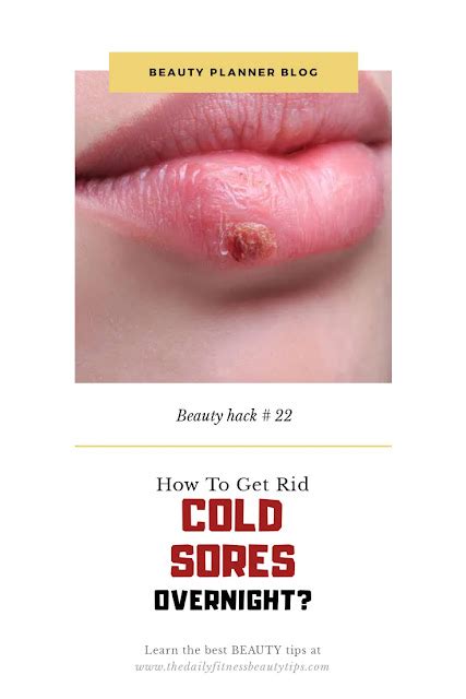 How To Get Rid Of Cold Sores Naturally