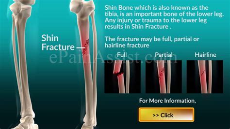 What Is Shin Fracturetibia Fracture Youtube