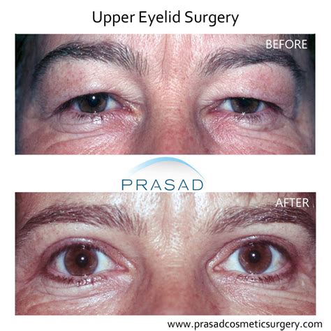 Blepharoplasty Eyelid Surgery Nyc And Long Island Dr Amiya Prasad