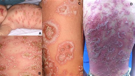 Pediatric Psoriasis With Metabolic Syndrome In Thai Children Ptt