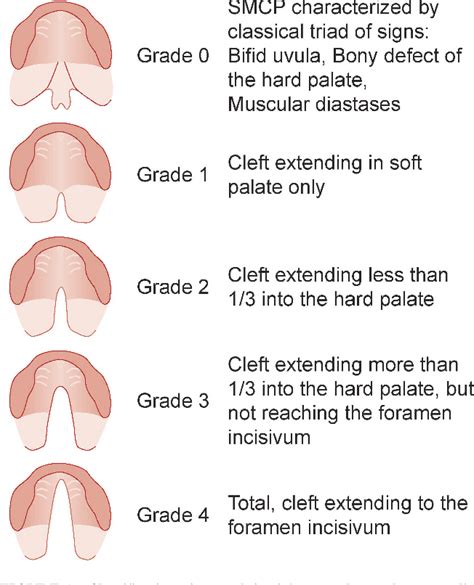 Clefts Of The Secondary Palate Referred To The Oslo Cleft Team