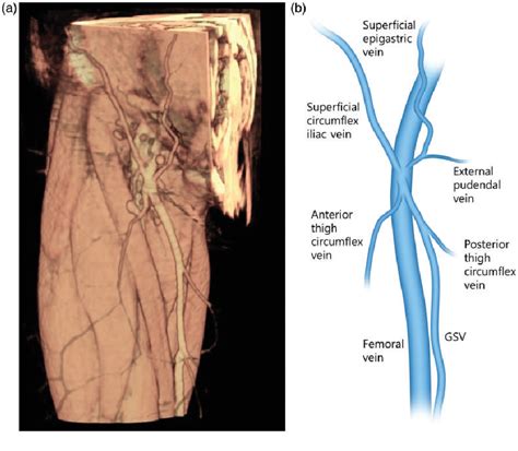 Figure 1 From Anatomic Variations Of Lower Extremity Venous System In