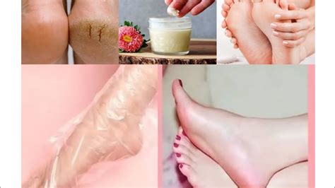 Get Beautiful Soft Feet Cracked Heels Removal Super Home Remedy With Noor Ali YouTube