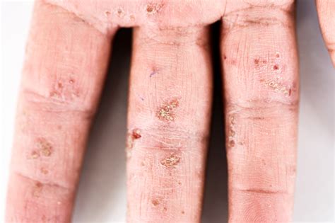 Dermatitis Atópica Foto De Stock Y Más Banco De Imágenes De Alergia