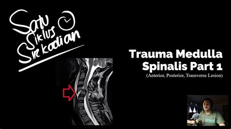 Trauma Medulla Spinalis Part 1 Anterior And Posterior Cord Syndrome