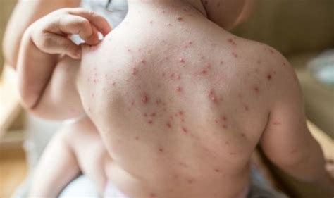 Chicken pox juga dikenali sebagai cacar air, jintungan atau bertih (mengikut dialek daerah). Chicken pox symptoms: Why do we get chicken pox? Can you ...