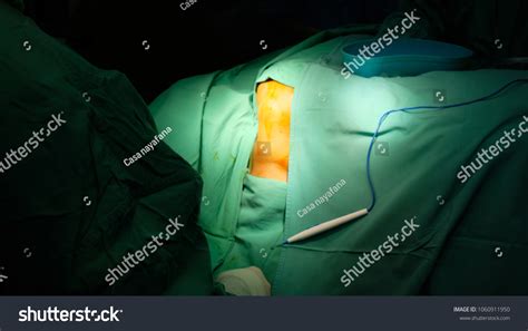Surgeon Performing Surgery Removing Lipoma Operation Stock Photo Edit