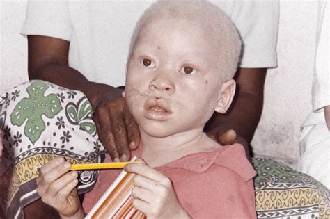 African Albino Foundation Drtenge