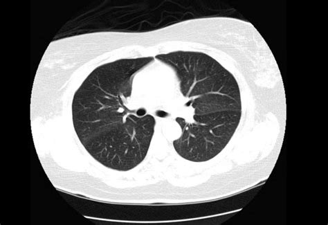 Pulmonary Edema Ct Wikidoc