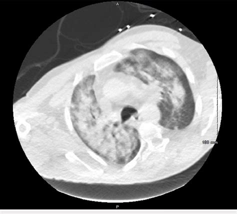 Chest Computed Tomography With Intravenous Contrast Demonstrating