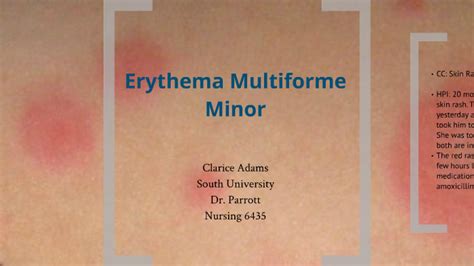 Erythema Multiforme By Clarice Winters