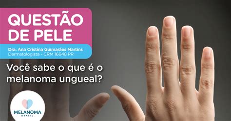 Você Sabe O Que é O Melanoma Ungueal • Instituto Melanoma Brasil