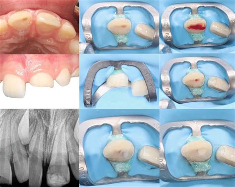 What Is Pulpotomy News Dentagama