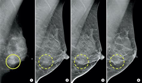 3 d mammograms may improve accuracy of breast cancer screening centre for imaging technology