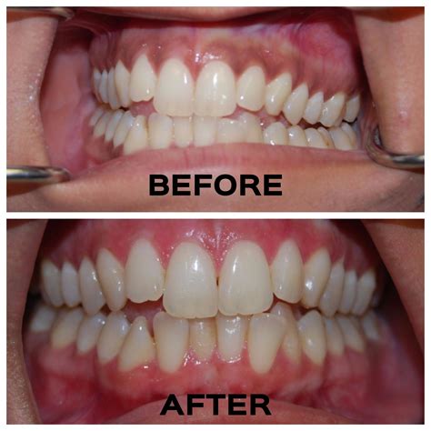Black Stains On Teeth Near Gums Teethwalls