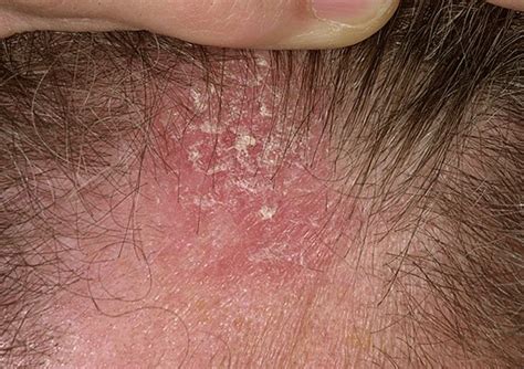Seborrheic Dermatitis Pictures On Face Scalp Hair Loss Causes