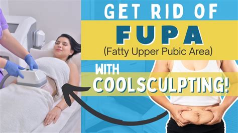 Do You Have A Fatty Upper Pubic Area Fupa Coolsculpting Might Be Your Answer Youtube