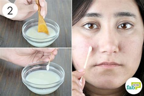 How To Get Rid Of Birthmarks With Lemon Juice Change Comin
