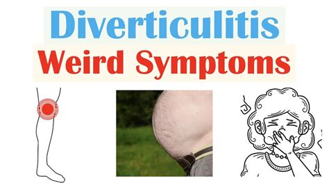 Weird Symptoms Of Diverticulitis Atypical Clinical Features Of