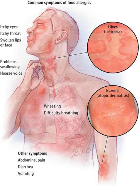 It causes a mild, itchy, red rash and may be accompanied by a fever, an upset stomach, and small red or purple spots on the skin. Food Allergies | Allergy and Clinical Immunology | JAMA ...