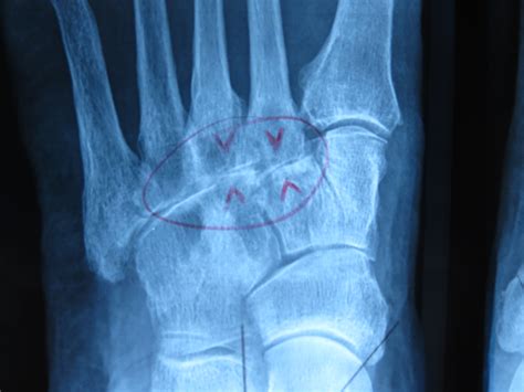 Most are located on the inferior part of the foot. Midfoot Pain - Pain on Top of the Foot - Natural Treatment