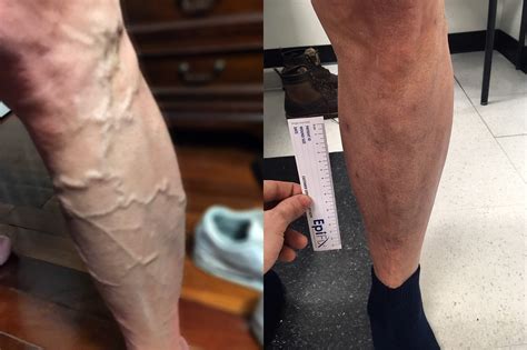 Varicose Vein Surgery Results Milford Vascular Institute