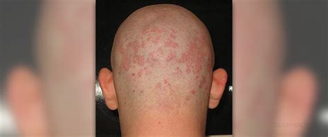 Seborrheic Dermatitis Body Skin And Hair Problems Articles Body