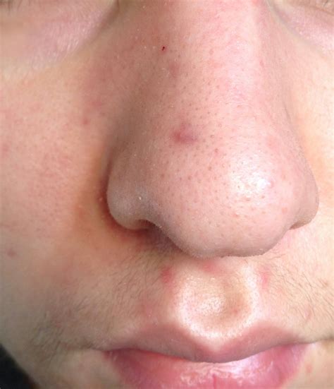 Hey Guys So Ive Had This Acne Scar On My Nose For Several Months Now