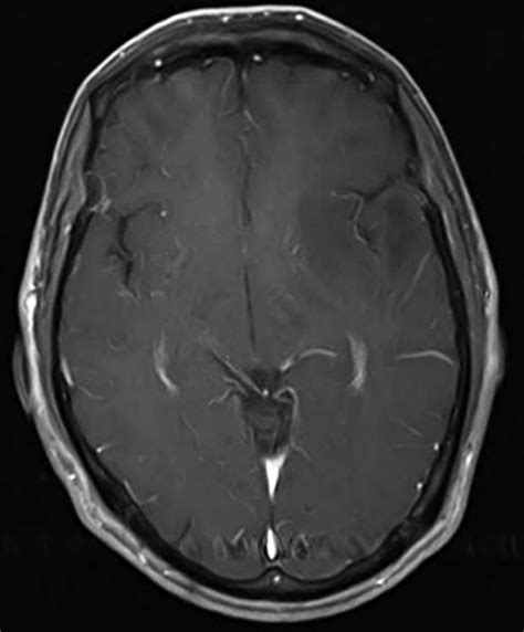 Axial Section Of Mri Brain T1 Post Contrast Image Of The Same Patient