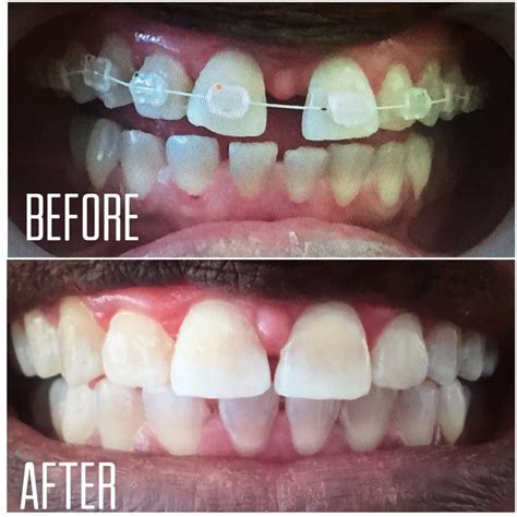 5 Before And After Invisalign Transformations Tooth Doctor