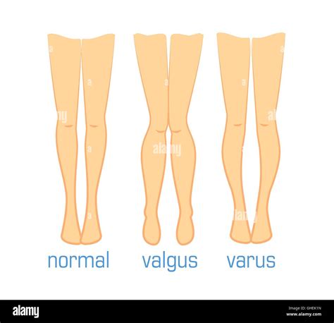 Valgus Varus And Normal Stock Vector Image And Art Alamy