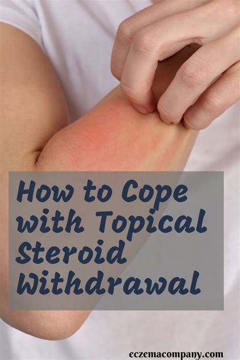 How To Cope With Topical Steroid Withdrawal In 2021 Topical Steroid