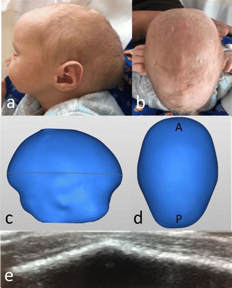 A B Preoperative Images Of 4 Day Old Boy With Scaphocephaly Case