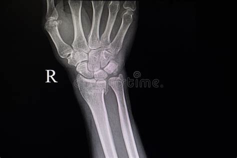 Xray Film Of Fracture Wrist Bones Stock Image Image Of Operation