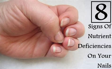 8 Signs Of Nutrient Deficiencies On Your Nails Brittle Nails Dry Nails Nails
