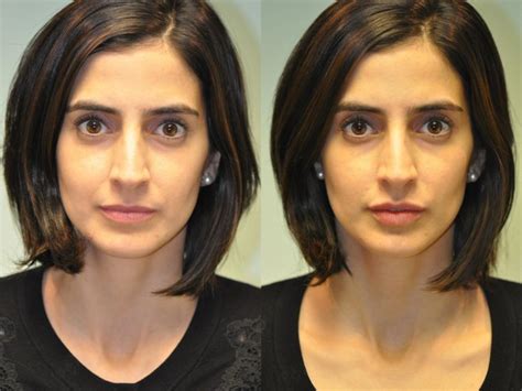 Lip Augmentation Photos Chevy Chase Md Patient 24516