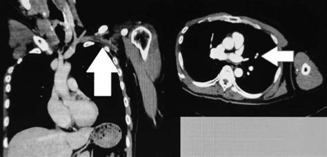 Figure2findings In Contrast Enhanced Computed Tomography At The