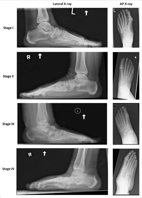 Anteroposterior And Lateral Radiographs Of Stages I Ii Iii And Iv