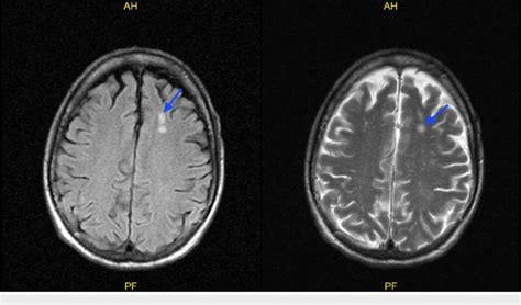 Mri Brain Without Contrast Showing Nonspecific White Matter Lesions In