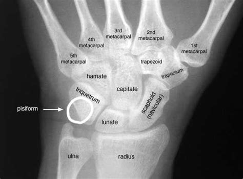 Wrist Joint X Ray