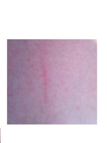 Sepsis may progress to septic shock. Ist das eine Blutvergiftung? habe echt Angst... (Medizin ...